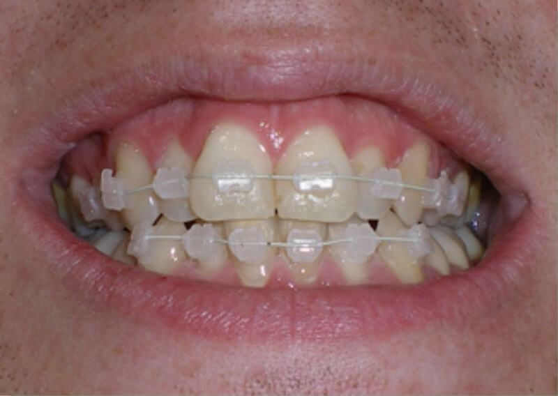 6 Month Braces