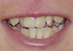 Before image of 20 year old girl, 4 side teeth removed, fixed braces