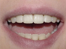 Before image of 20 year old girl, 4 side teeth removed, fixed braces