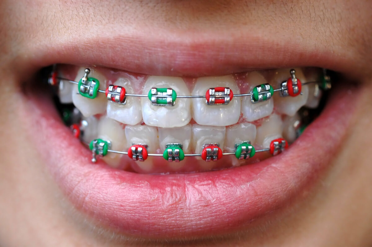 Close-up of a person's teeth with metal braces featuring red and green elastic bands