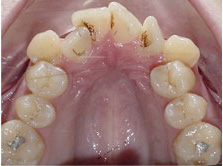 before image of 20 year old girl 4 side teeth removed, fixed braces - 19 months