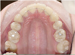 before image of 20 year old girl 4 side teeth removed, fixed braces - 19 months