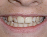 before image of 13 year old girl Close-up of smile with slightly misaligned front teeth, showing irregular spacing and a protruding tooth.