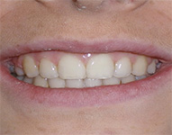 before image of 13 year old girl Close-up of smile with slightly misaligned front teeth, showing irregular spacing and a protruding tooth.