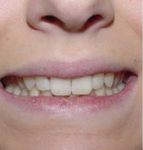 before image of 23 Year old Female Clear Braces on upper teeth only for 6 months