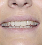 before image of 23 Year old Female Clear Braces on upper teeth only for 6 months