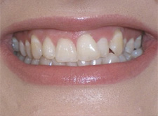 before image of 21 year old girl 2 teeth removed, white braces, 18 months