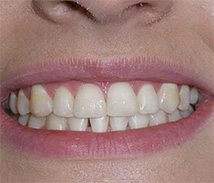 before image of 21 year old girl 2 teeth removed, white braces, 18 months