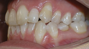 before image of 21 year old girl 2 teeth removed, white braces, 18 months