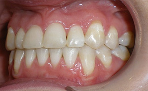 before image of 21 year old girl 2 teeth removed, white braces, 18 months