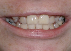 before image of 12 year old boy 2 upper teeth removed, fixed appliances, 22 months