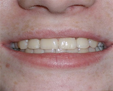 before image of 12 year old boy 2 upper teeth removed, fixed appliances, 22 months