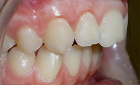 before image of 12 year old boy Side view of teeth showing an overbite and dental misalignment