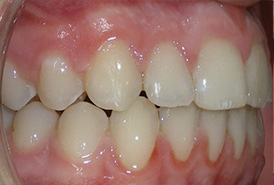 before image of 12 year old boy Side view of teeth showing an overbite and dental misalignment