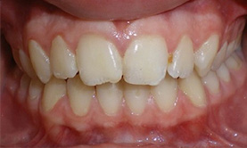 before image of 12 year old boy Close-up of teeth showing minor misalignment and crowding