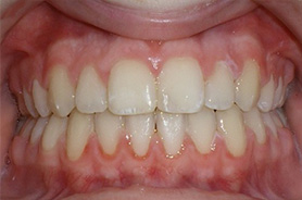 before image of 12 year old boy Close-up of teeth showing minor misalignment and crowding