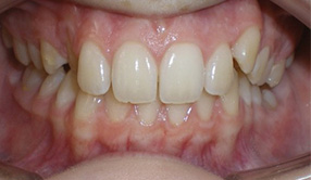 before image of 14 year old girl Close-up of teeth showing mild misalignment, with slightly crowded upper and lower front teeth