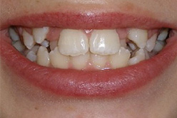 before image of 12 year old boy Close-up of smile showing severe crowding, misalignment, and overlapping front teeth