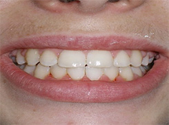 before image of 12 year old boy Close-up of smile showing severe crowding, misalignment, and overlapping front teeth