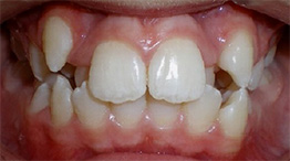 before image of 12 year old boy Close-up of teeth showing severe crowding, misalignment, and overlapping front teeth