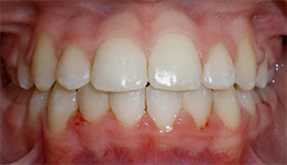 before image of 14 year old girl Close-up of teeth showing mild misalignment, with slightly crowded upper and lower front teeth