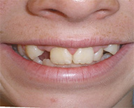 before image of 12 year old boy Close-up of smile showing severely misaligned, crowded, and irregularly spaced upper and lower teeth.