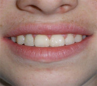 before image of 12 year old boy Close-up of smile showing severely misaligned, crowded, and irregularly spaced upper and lower teeth.