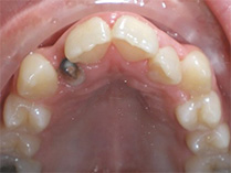 before image of 12 year old boy intraoral view of the upper teeth showing crowding, misalignment, and a visible cavity on a molar