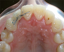 before image of 12 year old boy intraoral view of the upper teeth showing crowding, misalignment, and a visible cavity on a molar