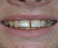 before image of 13 year old girl 2 upper teeth removed, fixed appliances, 19 months