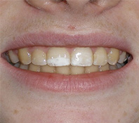 before image of 13 year old girl 2 upper teeth removed, fixed appliances, 19 months