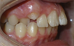 before image of 13 year old girl 2 upper teeth removed, fixed appliances, 19 months