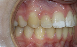 before image of 13 year old girl 2 upper teeth removed, fixed appliances, 19 months