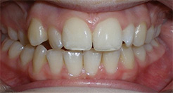 before image of 13 year old girl Close-up of teeth showing moderate misalignment, with overlapping front teeth and uneven spacing