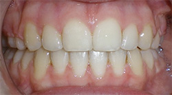 before image of 13 year old girl Close-up of teeth showing moderate misalignment, with overlapping front teeth and uneven spacing