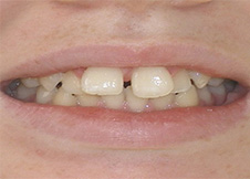 after image of 13 year old girl non extraction, fixed appliances & frenectomy, 21 months