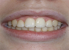 after image of 13 year old girl non extraction, fixed appliances & frenectomy, 21 months