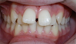 before image of 13 year old girl Close-up of teeth showing misalignment, spacing, and an overbite