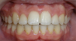 before image of 13 year old girl Close-up of teeth showing misalignment, spacing, and an overbite