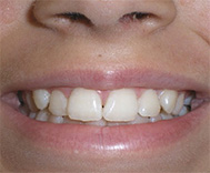 before image of 12 year old girl Close-up of smile showing misaligned and crowded teeth, with noticeable spacing and uneven tooth positioning