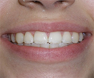 before image of 12 year old girl Close-up of smile showing misaligned and crowded teeth, with noticeable spacing and uneven tooth positioning