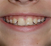 before image of 14 year old girl Close-up of smile showing misaligned and chipped front teeth