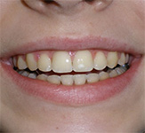 before image of 14 year old girl Close-up of smile showing misaligned and chipped front teeth