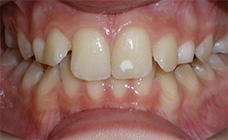 before image of 14 year old girl Close-up of teeth showing severe crowding, misalignment, and a white spot on one front tooth