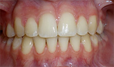 before image of 14 year old girl Close-up of teeth showing severe crowding, misalignment, and a white spot on one front tooth