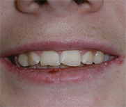 before image of 14 year old boy 2 upper teeth removed for protrusion and worn teeth smoothened at end fixed appliances, 22 months