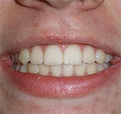 before image of 11 year old boy Close-up of mouth with slightly misaligned teeth and a subtle smile