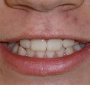 before image of 11 year old boy Close-up of mouth with slightly misaligned teeth and a subtle smile