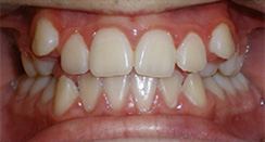 before image of 11 year old boy Close-up of teeth showing severe crowding and misalignment