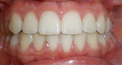 before image of 11 year old boy Close-up of teeth showing severe crowding and misalignment